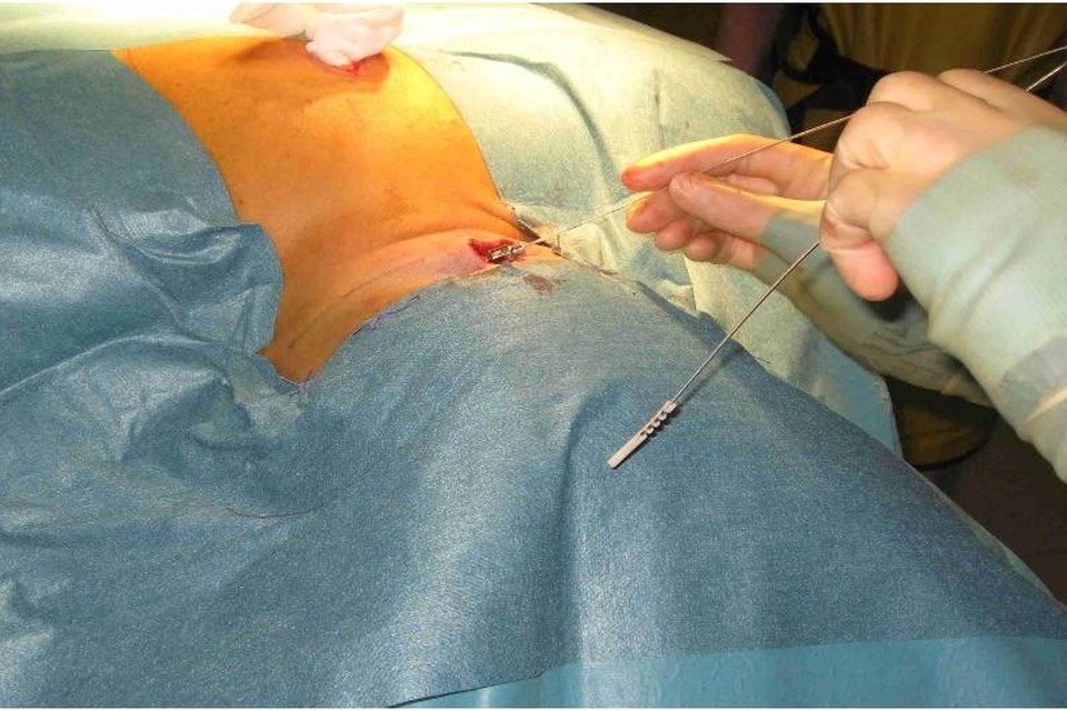 Neurostimulator wordt tijdens operatie in nek van patiënt geplaatst.