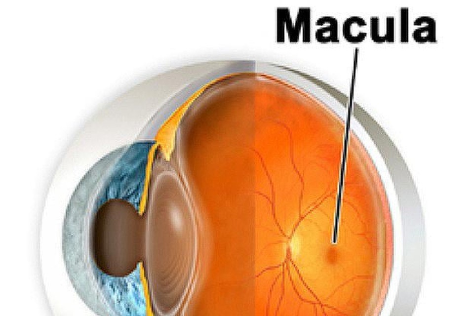 Een oog met macula degeneratie.