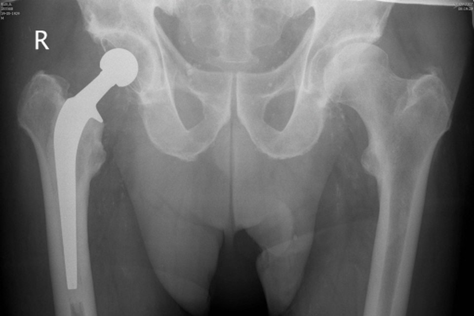 Een gewone röntgenfoto van een heupprothese. Op zo’n foto is een beweging niet te detecteren. Archieffoto Leidsch Dagblad