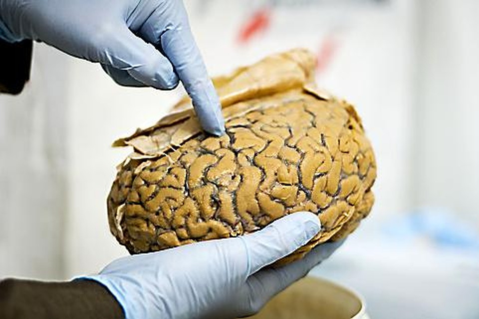 Voor het onderzoek zijn geen echte hersenen nodig, maar een model gemaakt van huidcellen.